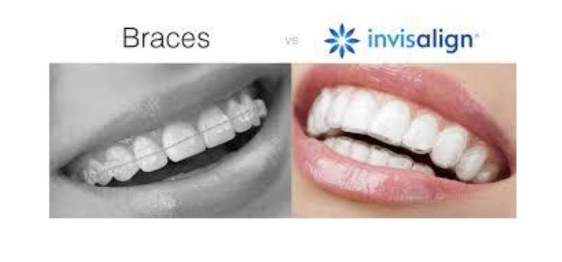 Benefits of Invisalign